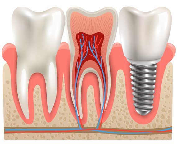 Что такое имплантация зубов. Из чего состоит имплант