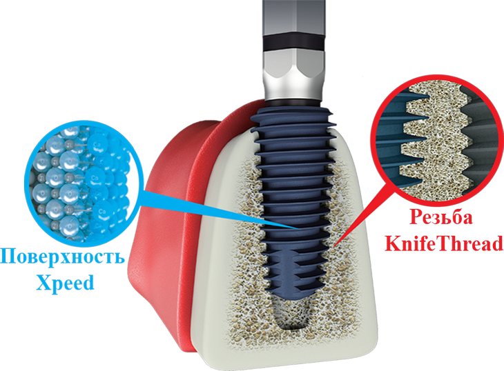 Виды имплантов MegaGen (Мегаген)