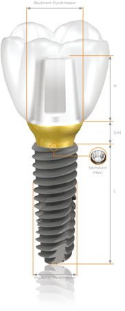 Виды имплантов Osstem