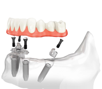 Имплантация All-on-4/6