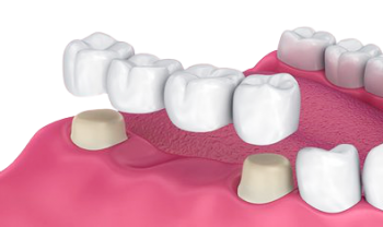 Мостовидные протезы