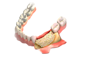 Наращивание костной ткани