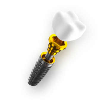 Одномоментная имплантация