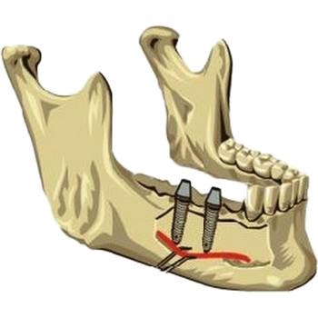 Перемещение нижнечелюстного нерва