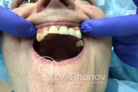 Кейс №2 - Протезирование верхней и нижней челюсти по технологии All-on-4/6 / 