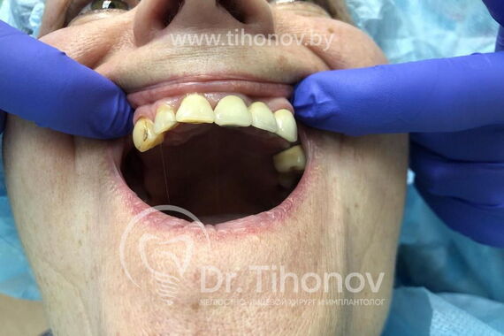 Кейс №2 - Протезирование верхней и нижней челюсти по технологии All-on-4/6 / 1