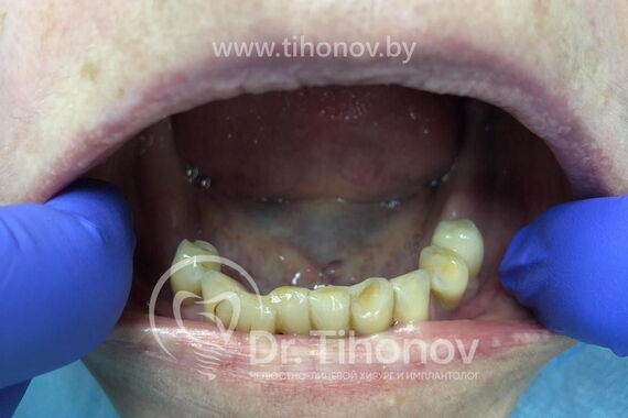 Кейс №2 - Протезирование верхней и нижней челюсти по технологии All-on-4/6 / 2