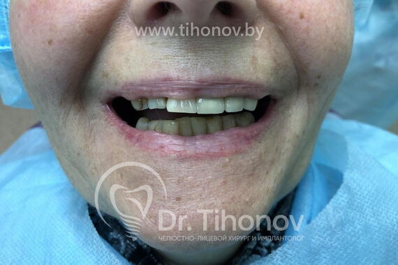 Кейс №2 - Протезирование верхней и нижней челюсти по технологии All-on-4/6 / 