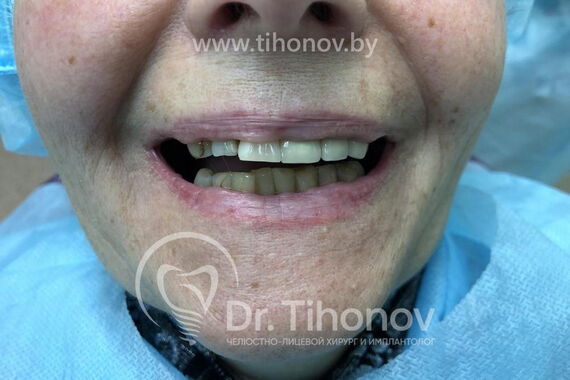 Кейс №2 - Протезирование верхней и нижней челюсти по технологии All-on-4/6 / 3