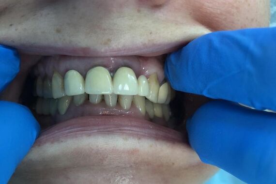 Кейс №1 - Установка несъемных протезов на обе челюсти за 5 дней / 