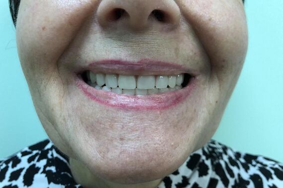 Кейс №2 - Протезирование верхней и нижней челюсти по технологии All-on-4/6 / 0