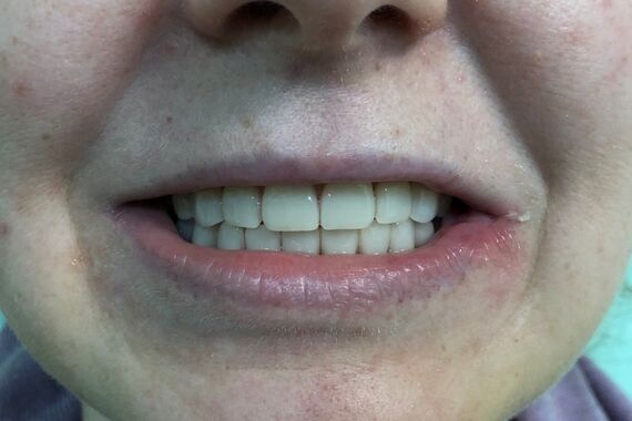 Кейс №1 - Установка несъемных протезов на обе челюсти за 5 дней / 1