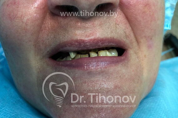 Кейс №4 - Протезирование верхней челюсти All-on-6 / 