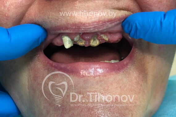 Кейс №4 - Протезирование верхней челюсти All-on-6 / 