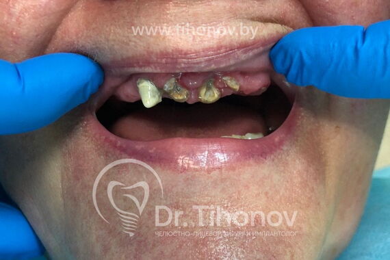 Кейс №4 - Протезирование верхней челюсти All-on-6 / 1