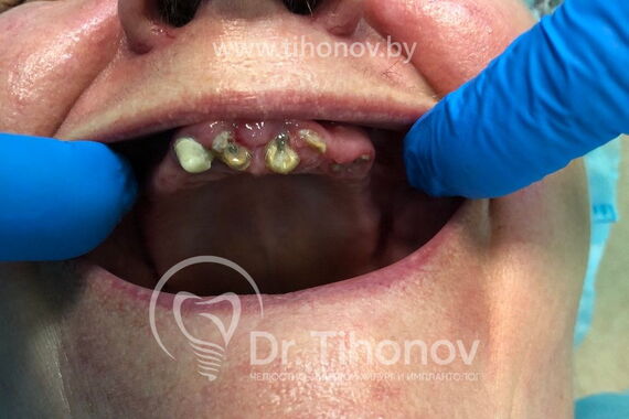 Кейс №4 - Протезирование верхней челюсти All-on-6 / 2