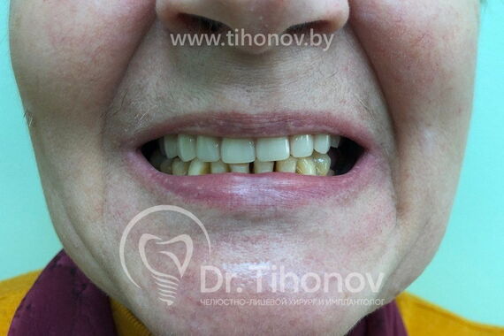 Кейс №4 - Протезирование верхней челюсти All-on-6 / 0