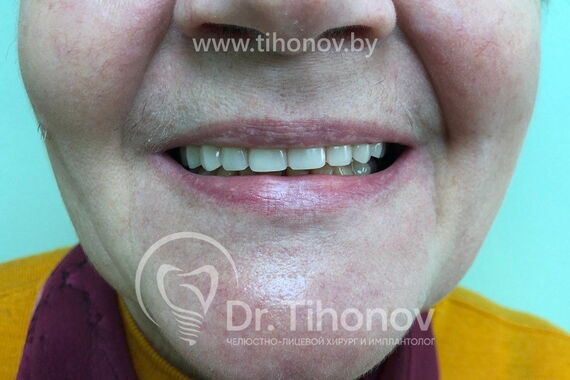 Кейс №4 - Протезирование верхней челюсти All-on-6 / 1