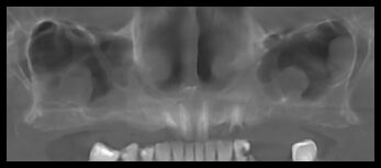 Кейс №4 - Протезирование верхней челюсти All-on-6 / 