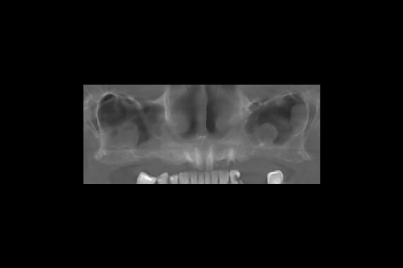 Кейс №4 - Протезирование верхней челюсти All-on-6 / 3