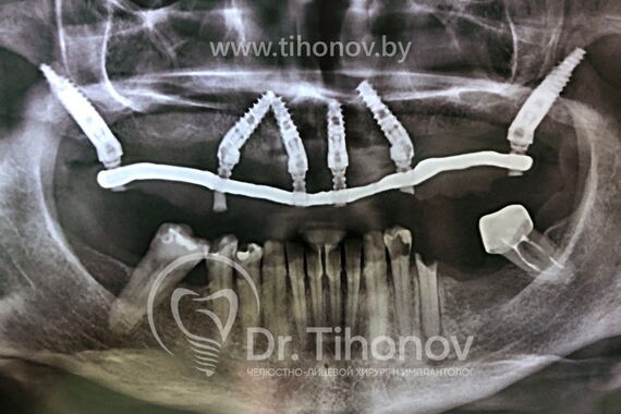 Кейс №4 - Протезирование верхней челюсти All-on-6 / 3