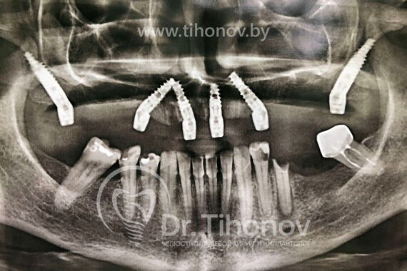 Кейс №4 - Протезирование верхней челюсти All-on-6 / 2