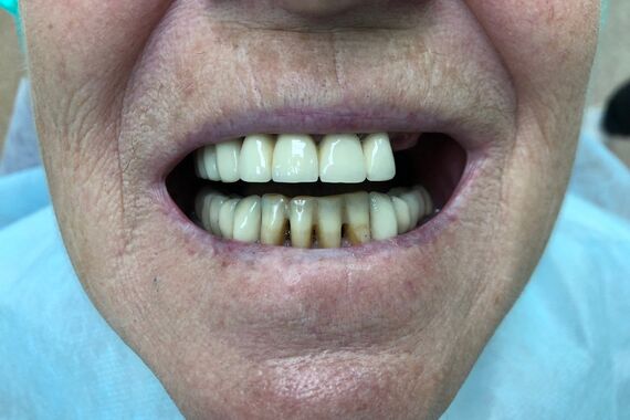 Кейс №5 - Установка 6 имплантов и несъемного протеза за 4 дня / 