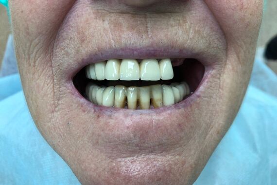 Кейс №5 - Установка 6 имплантов и несъемного протеза за 4 дня / 0