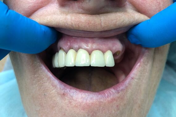 Кейс №5 - Установка 6 имплантов и несъемного протеза за 4 дня / 