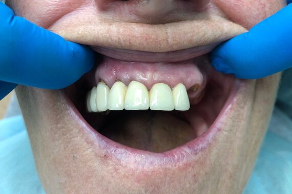 Кейс №5 - Установка 6 имплантов и несъемного протеза за 4 дня / 1