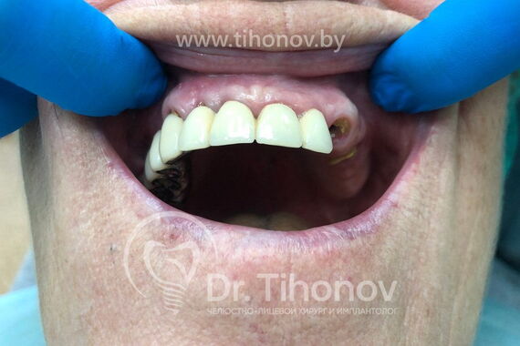 Кейс №5 - Установка 6 имплантов и несъемного протеза за 4 дня / 