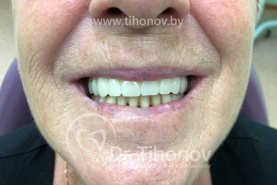 Кейс №5 - Установка 6 имплантов и несъемного протеза за 4 дня / 0