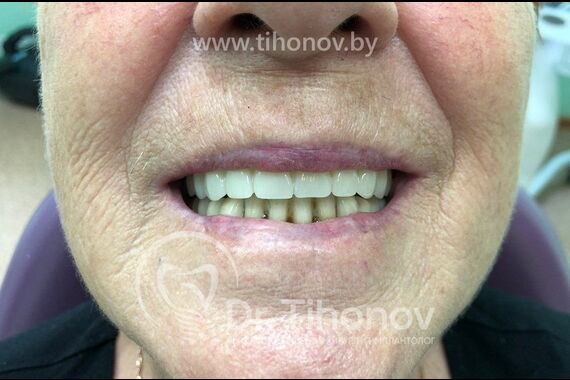 Кейс №5 - Установка 6 имплантов и несъемного протеза за 4 дня / 1