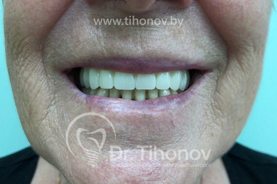 Кейс №5 - Установка 6 имплантов и несъемного протеза за 4 дня / 2