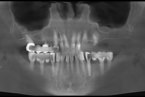 Кейс №5 - Установка 6 имплантов и несъемного протеза за 4 дня / 