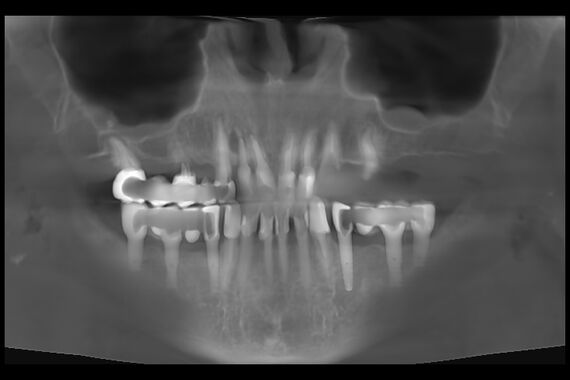 Кейс №5 - Установка 6 имплантов и несъемного протеза за 4 дня / 3