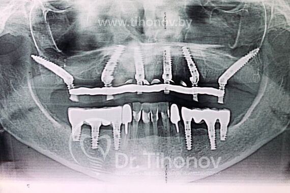Кейс №5 - Установка 6 имплантов и несъемного протеза за 4 дня / 3