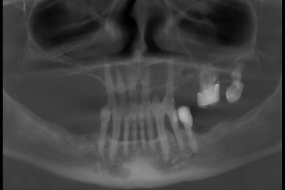 Кейс №2 - Протезирование верхней и нижней челюсти по технологии All-on-4/6 / 