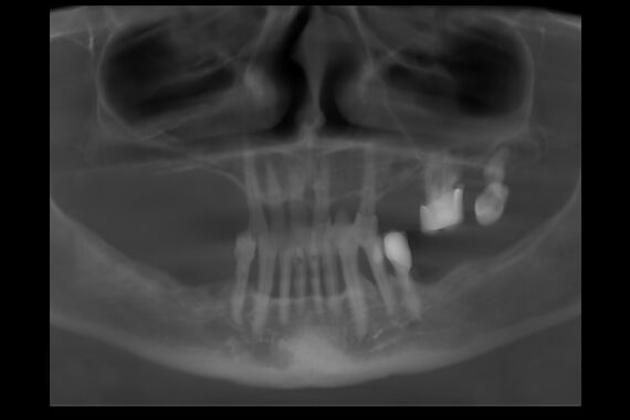 Кейс №2 - Протезирование верхней и нижней челюсти по технологии All-on-4/6 / 0
