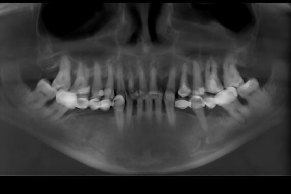 Кейс №1 - Установка несъемных протезов на обе челюсти за 5 дней / 