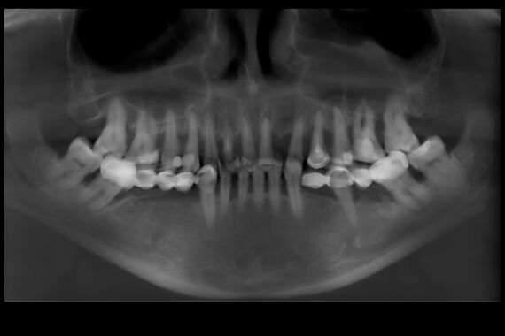 Кейс №1 - Установка несъемных протезов на обе челюсти за 5 дней / 0