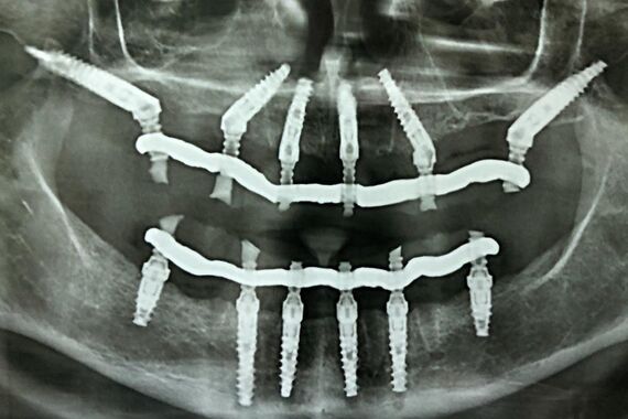 Кейс №2 - Протезирование верхней и нижней челюсти по технологии All-on-4/6 / 1