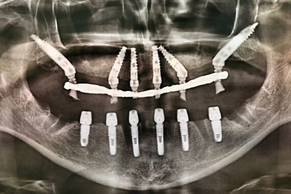 Кейс №1 - Установка несъемных протезов на обе челюсти за 5 дней / 0