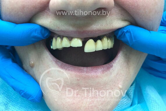 Кейс №3 - Имплантация и протезирование All-on-6 / 