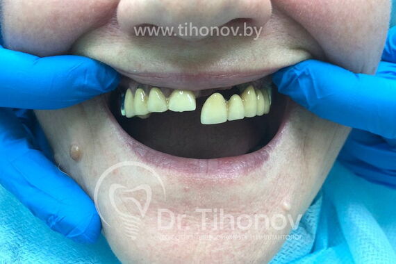 Кейс №3 - Имплантация и протезирование All-on-6 / 0