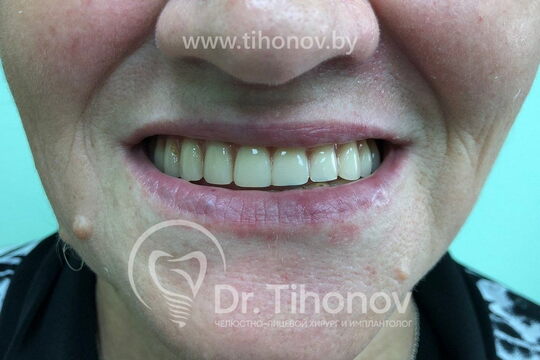 Кейс №3 - Имплантация и протезирование All-on-6