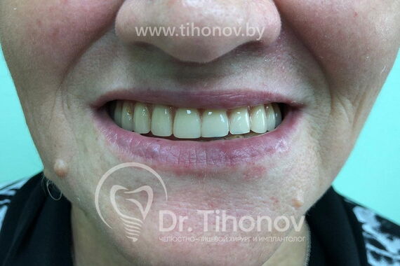 Кейс №3 - Имплантация и протезирование All-on-6 / 0