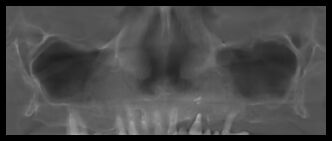 Кейс №3 - Имплантация и протезирование All-on-6 / 