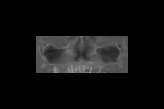 Кейс №3 - Имплантация и протезирование All-on-6 / 1