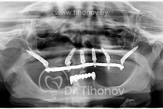 Кейс №3 - Имплантация и протезирование All-on-6 / 1